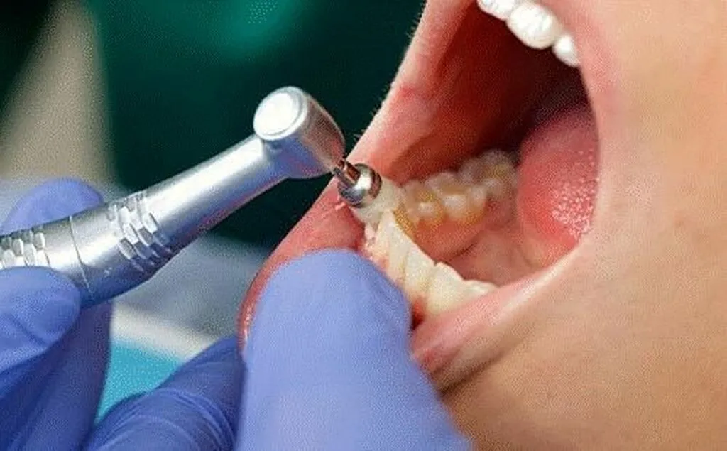 PMTC (プロによる歯のクリーニング)とは